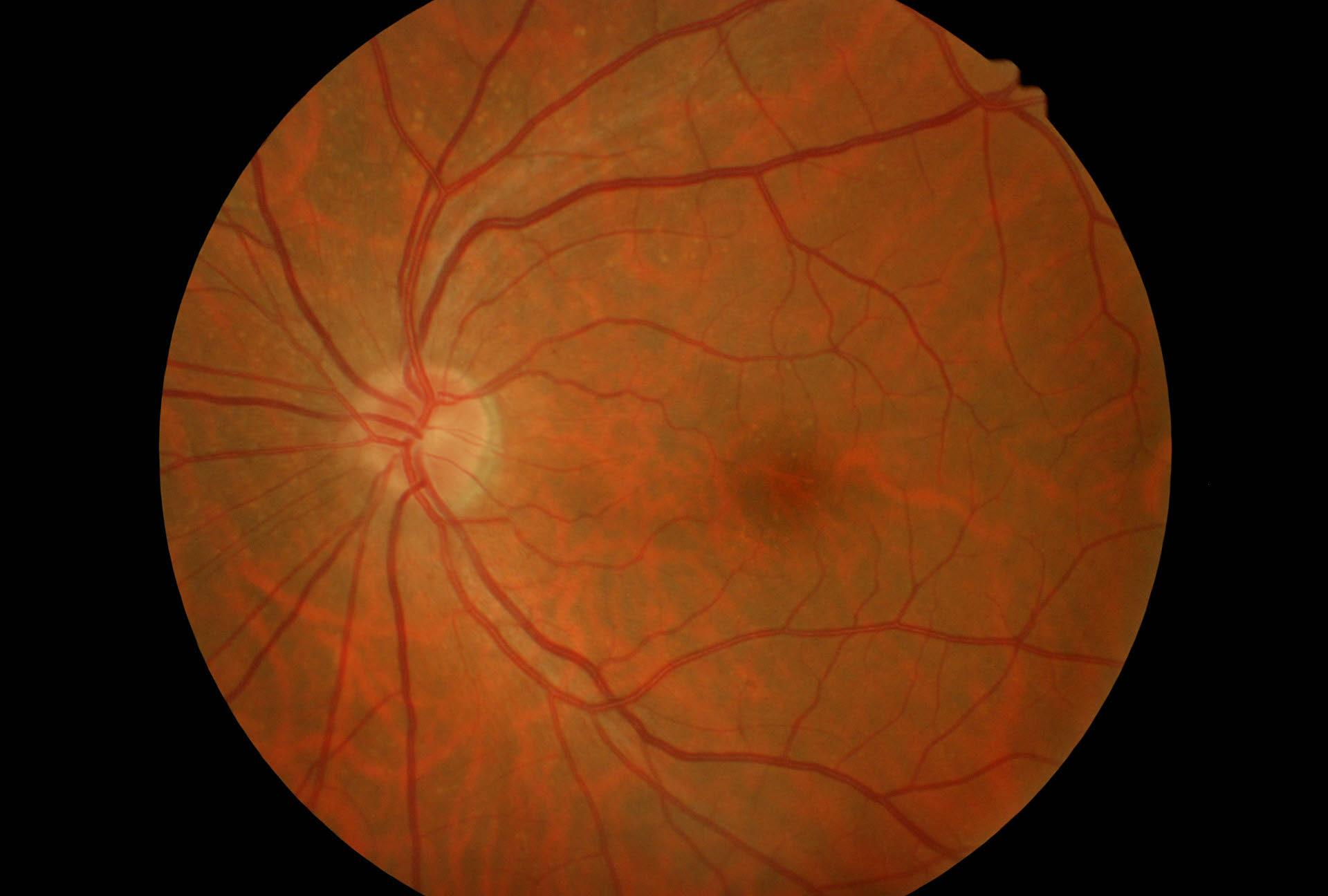 Esame del fondo oculare (fundus oculi)